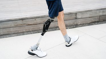 Cetak 3D Prosthetics , Solusi Bagi yang Kehilangan Anggota Tubuh